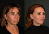 Kā izskatās parastas sievietes vecumā no 50 līdz 70 gadiem, kuras veikušas sejas uzlabošanu